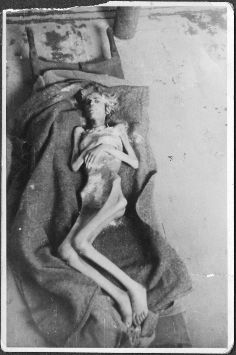 An emaciated female survivor who has just been disinfected lies on a stretcher in Bergen-Belsen.