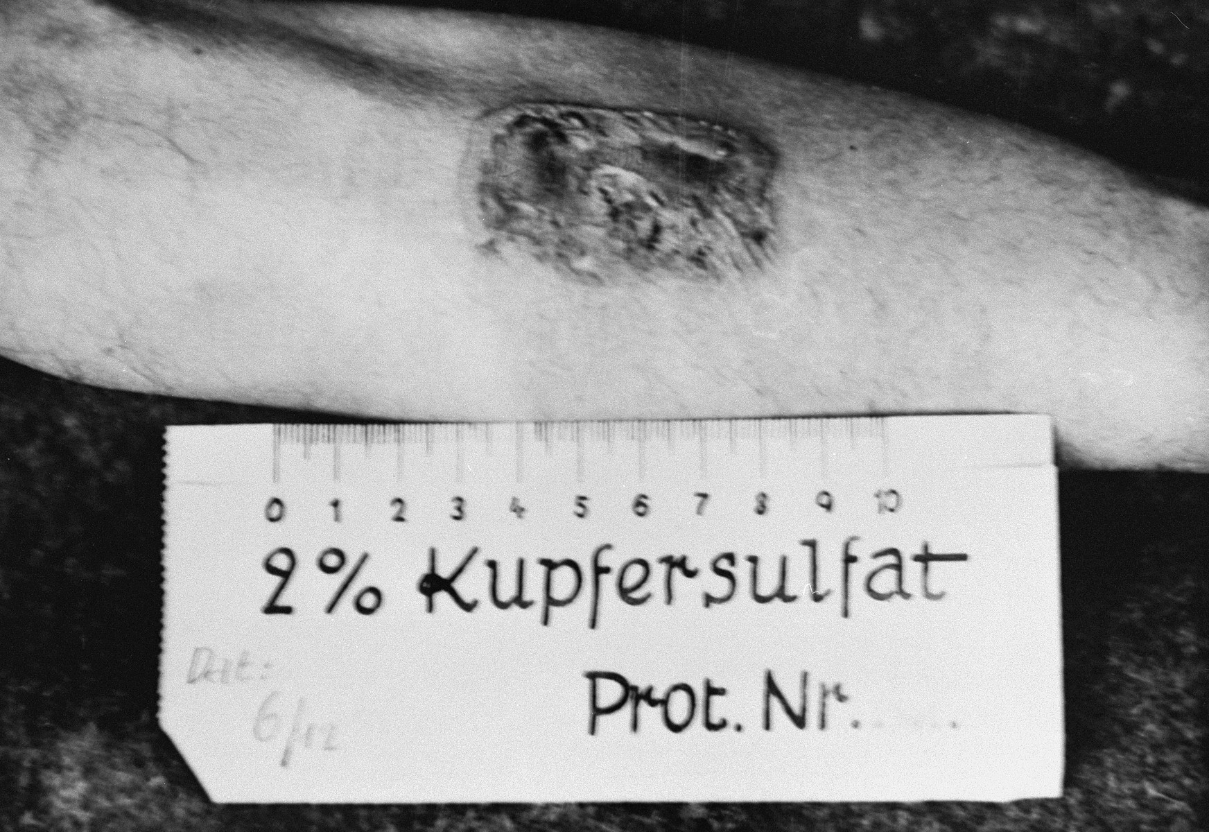 A photograph of the results of a medical experiment dealing with phosphorous that was carried out by doctors at Ravensbrueck.  

In the experiment, a mixture of phosphorus and rubber was applied to the skin and ignited.  After twenty seconds, the fire was extinguished with water and then wiped with R17.  After three days, the burn was treated with Echinacin in liquid form.  After two weeks the wound had healed.  This photograph, taken by a camp physician, was entered as evidence during the Doctors Trial at Nuremberg.