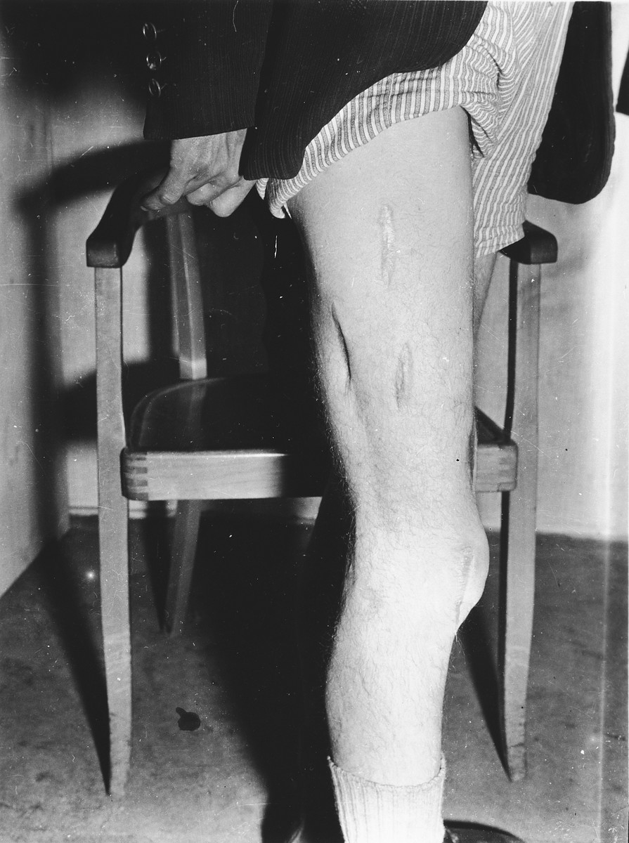 Close-up view of the badly scarred leg of a survivor who was probably the victim of medical experimentation in the Dachau concentration camp .