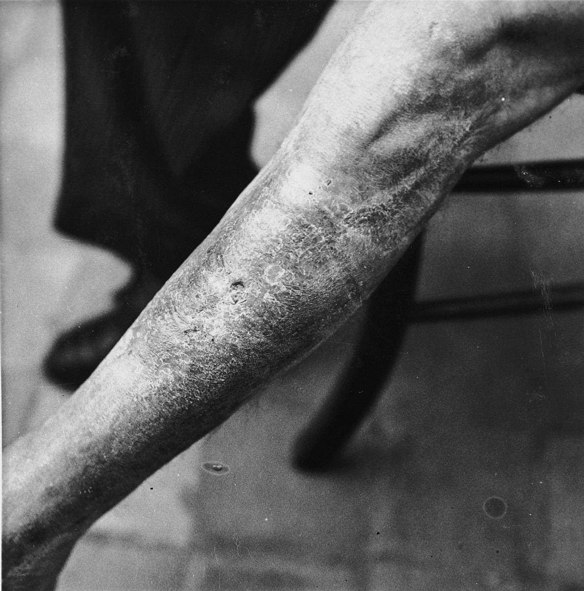 Emile Scieur shows the scarring on his leg that resulted from being beaten with a rubber truncheon in the Breendonck internment camp.