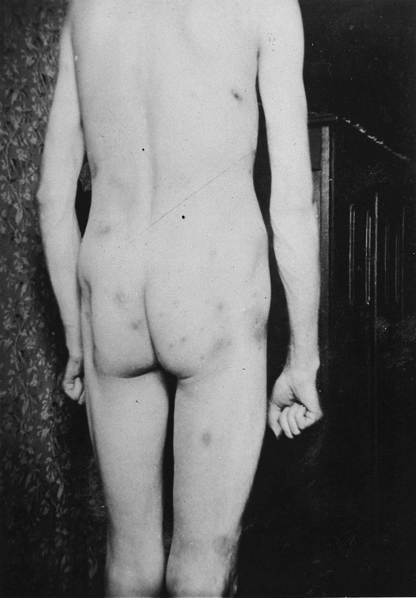 A survivor shows the scars on his body as a result of torture in the Breendonck internment camp.