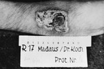 A photograph of the results of a medical experiment dealing with phosphorous that was carried out by doctors at Ravensbrueck.