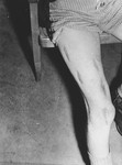 Close-up view of the badly scarred leg of a survivor who was probably the victim of medical experimentation in the Dachau concentration camp.