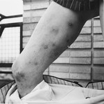 Mr. Van Hove shows the scars on his legs as a result of his torture in the Breendonck internment camp.