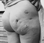 Madame Pacquet displays scars that she received as the result of torture in the Breendonck internment camp.